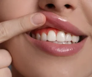 Fogorvosi vizsgálat során az íny állapotának ellenőrzése. A duzzadt, vörös vagy vérző íny gyakran ínygyulladás vagy fogágybetegség jele lehet, amely időben kezelve megelőzheti a komolyabb fogászati problémákat.