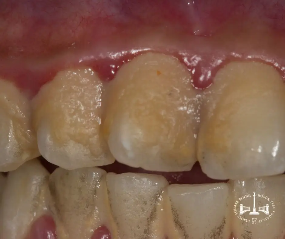 plakk, fogkő, gyulladt íny